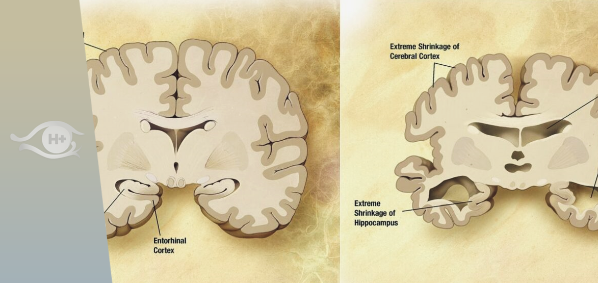 Lettre mensuelle de Heales. La mort de la mort. N°167. Février 2023. . Maladies neurodégénératives et vieillissement.